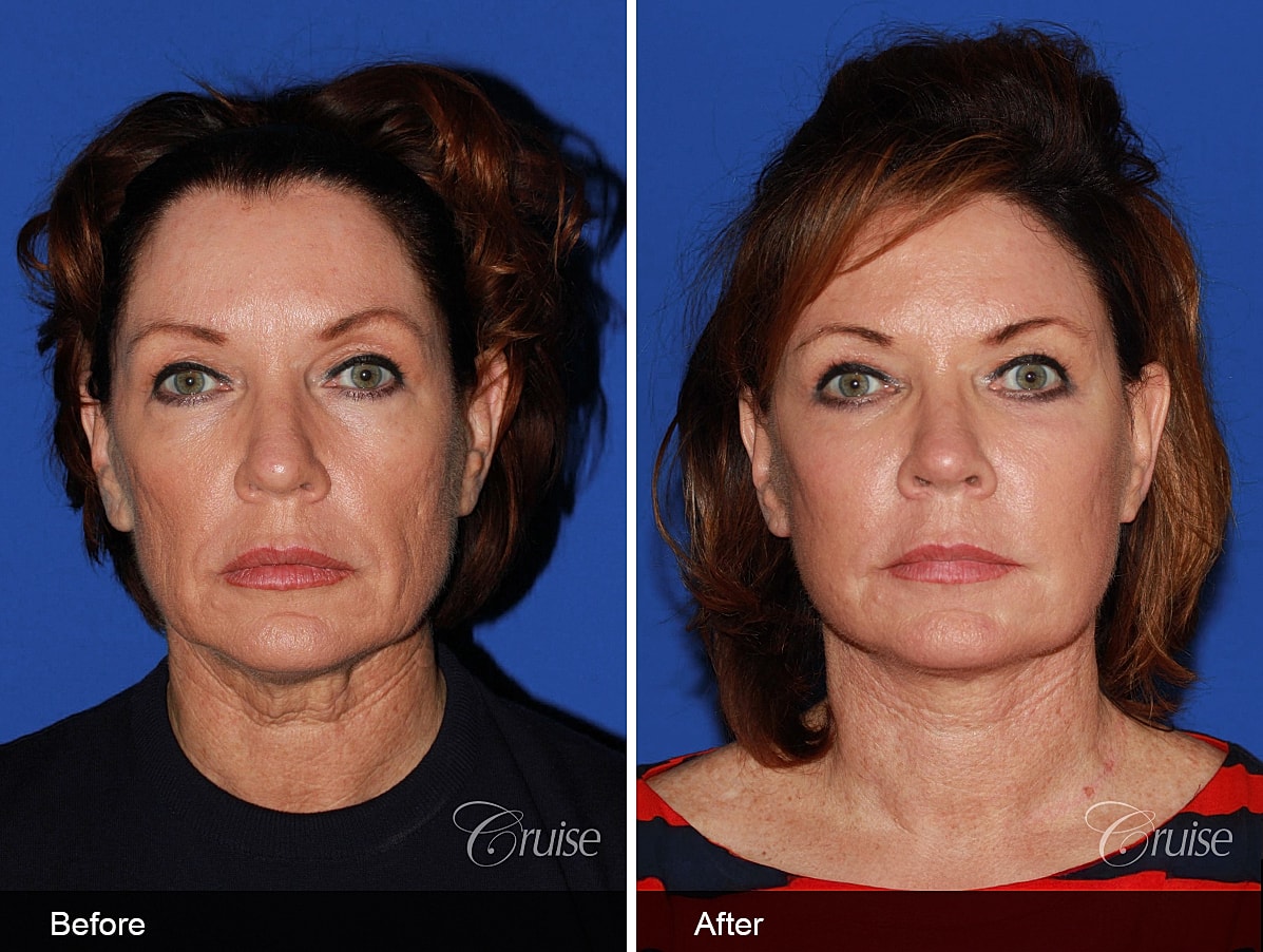 Face Lift Before & After