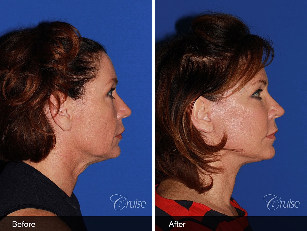 Face Lift Before & After