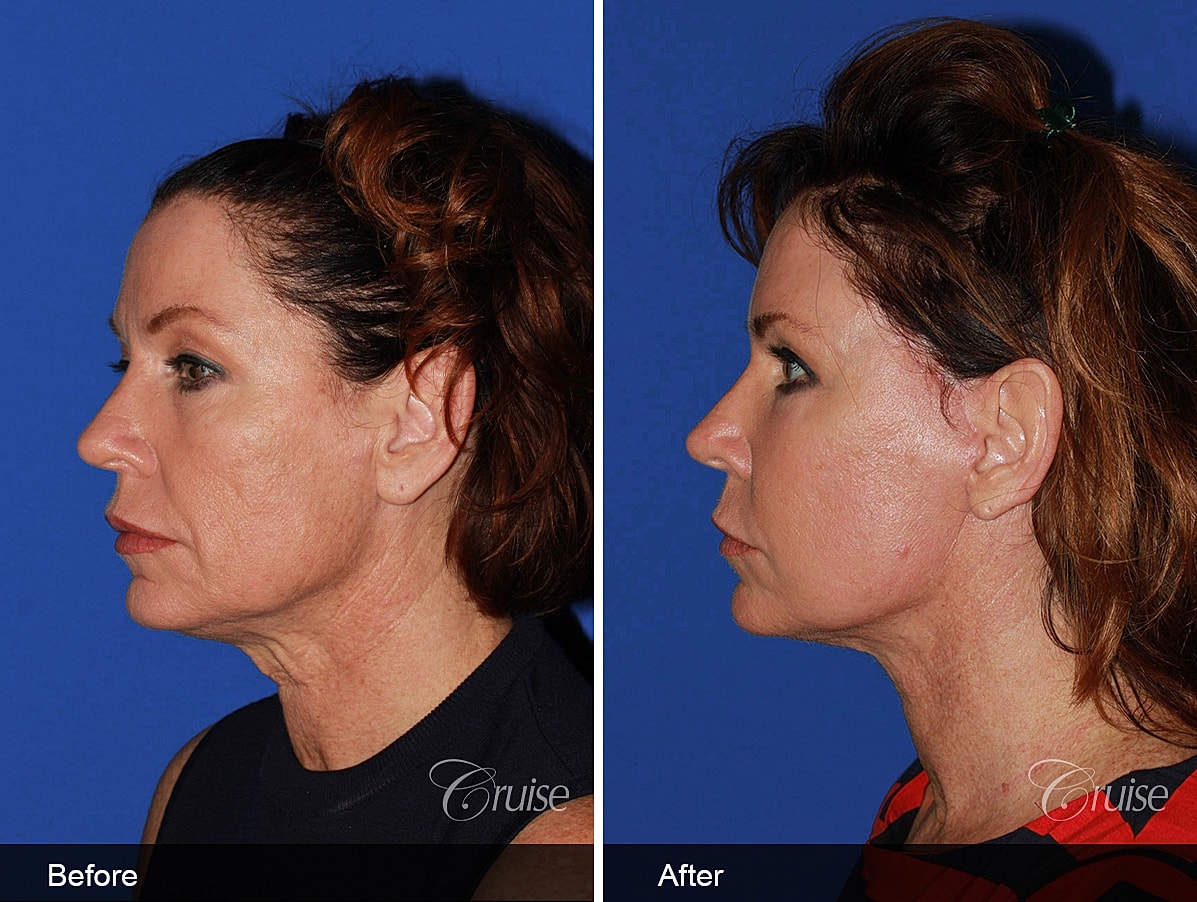 Face Lift Before & After