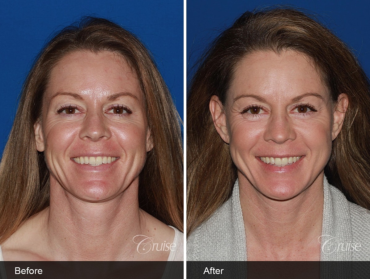 Face Lift Before & After