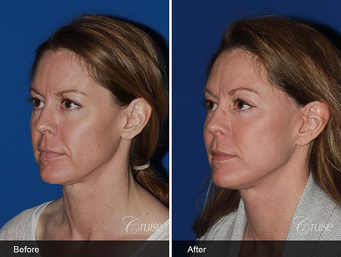 Face Lift Before & After