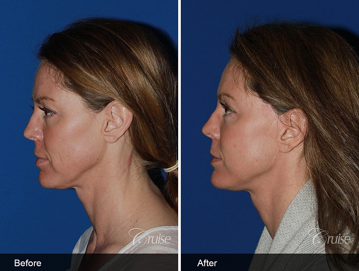 Face Lift Before & After