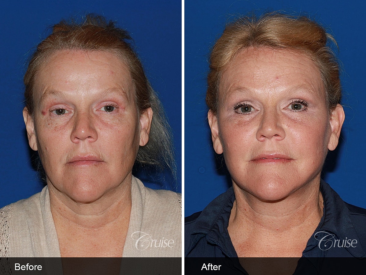 Face Lift Before & After