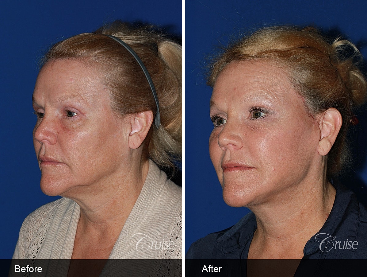 Face Lift Before & After