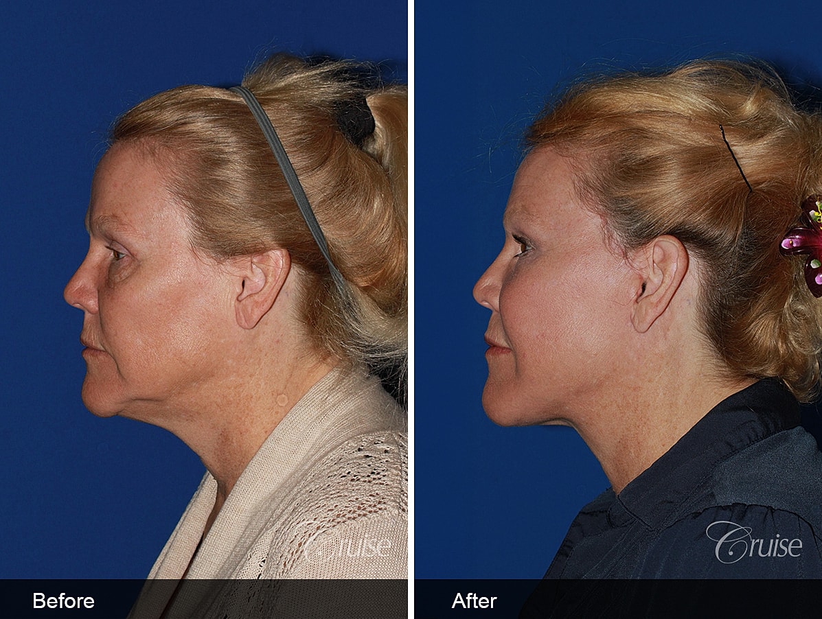 Face Lift Before & After