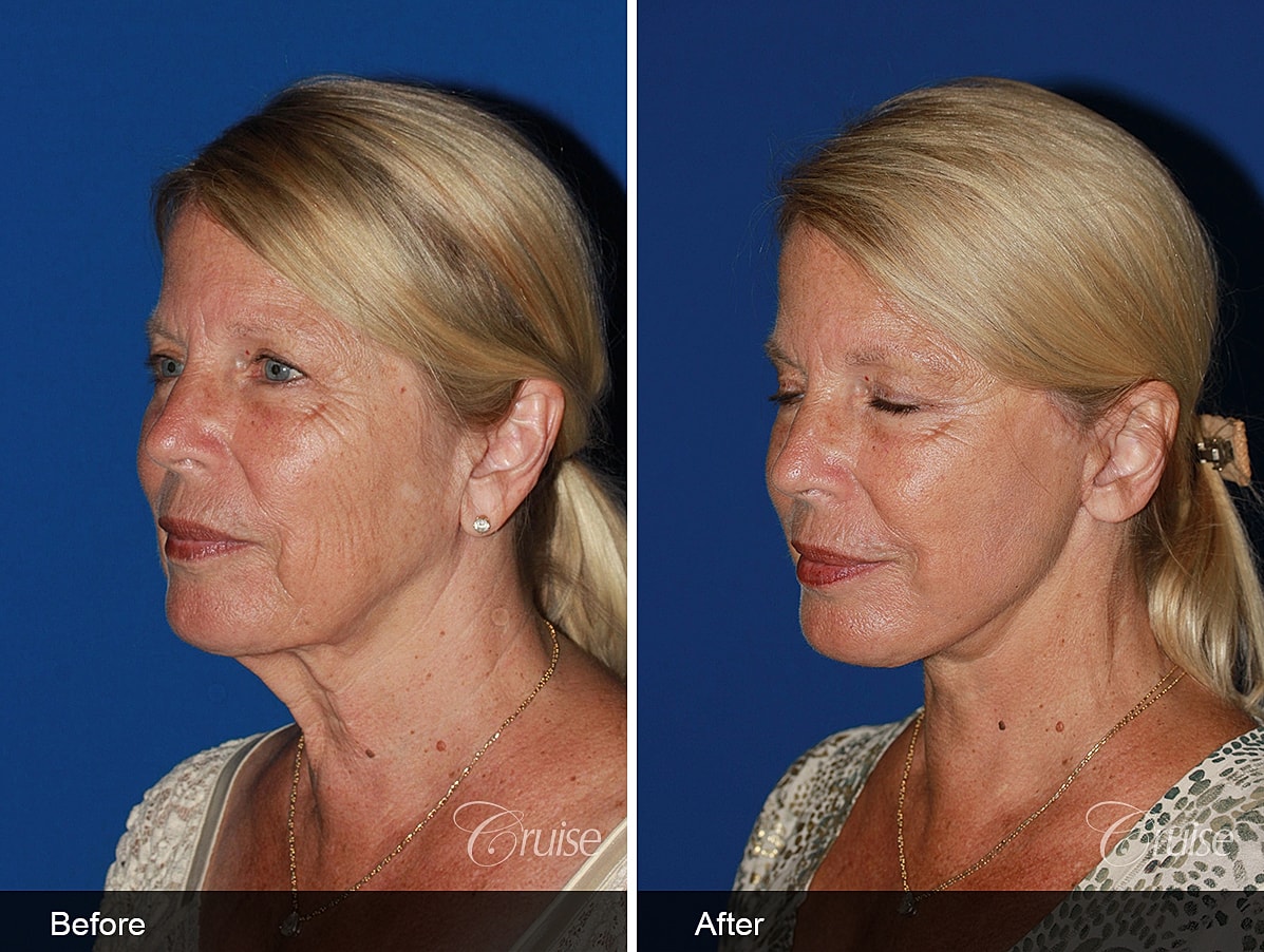 Face Lift Before & After