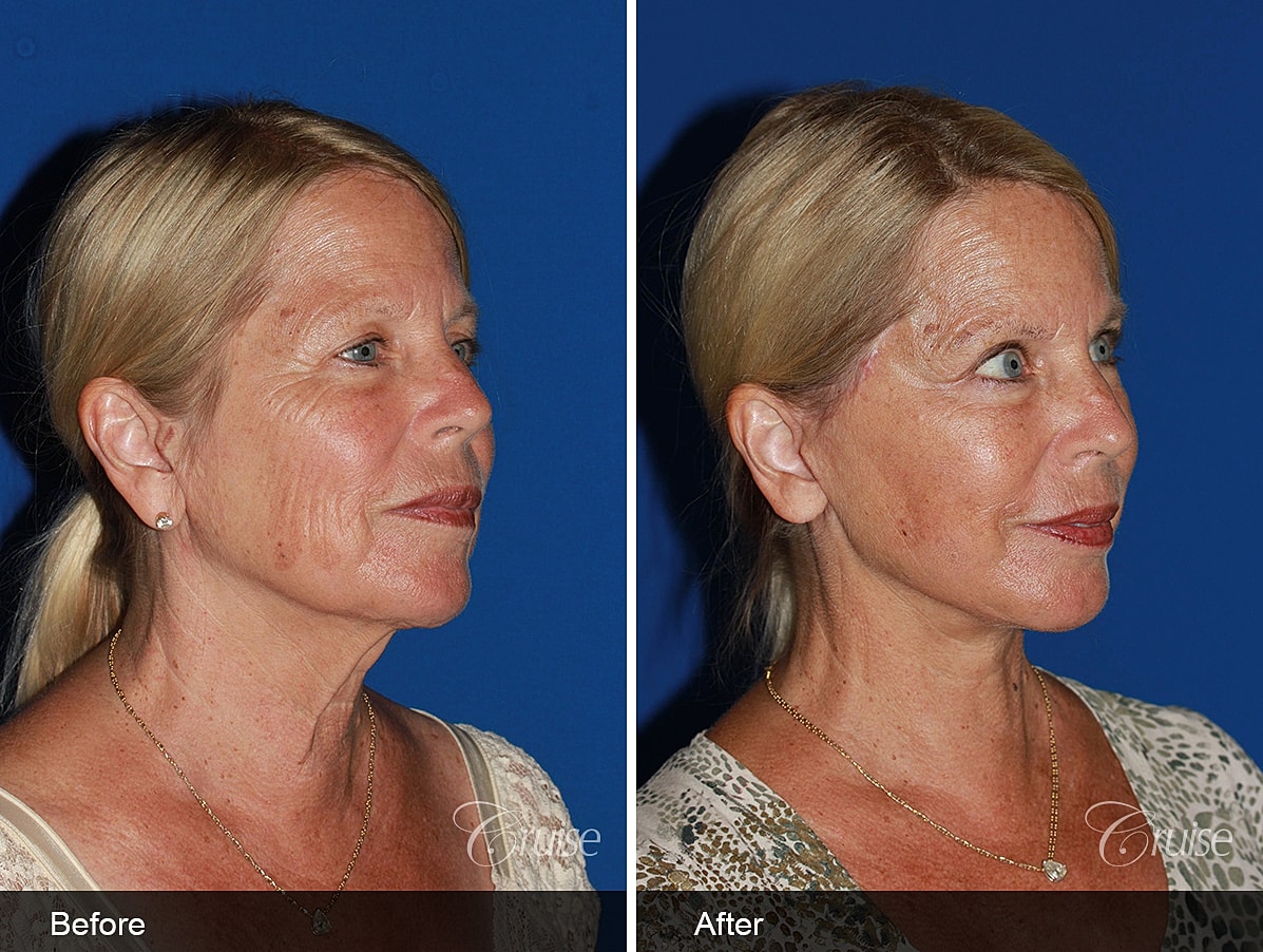 Face Lift Before & After