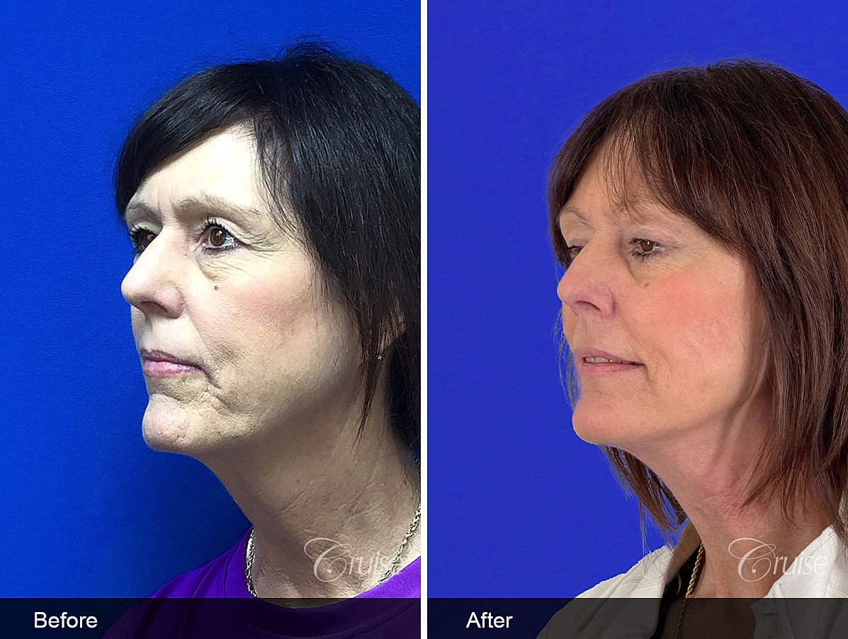 Face Lift Before & After