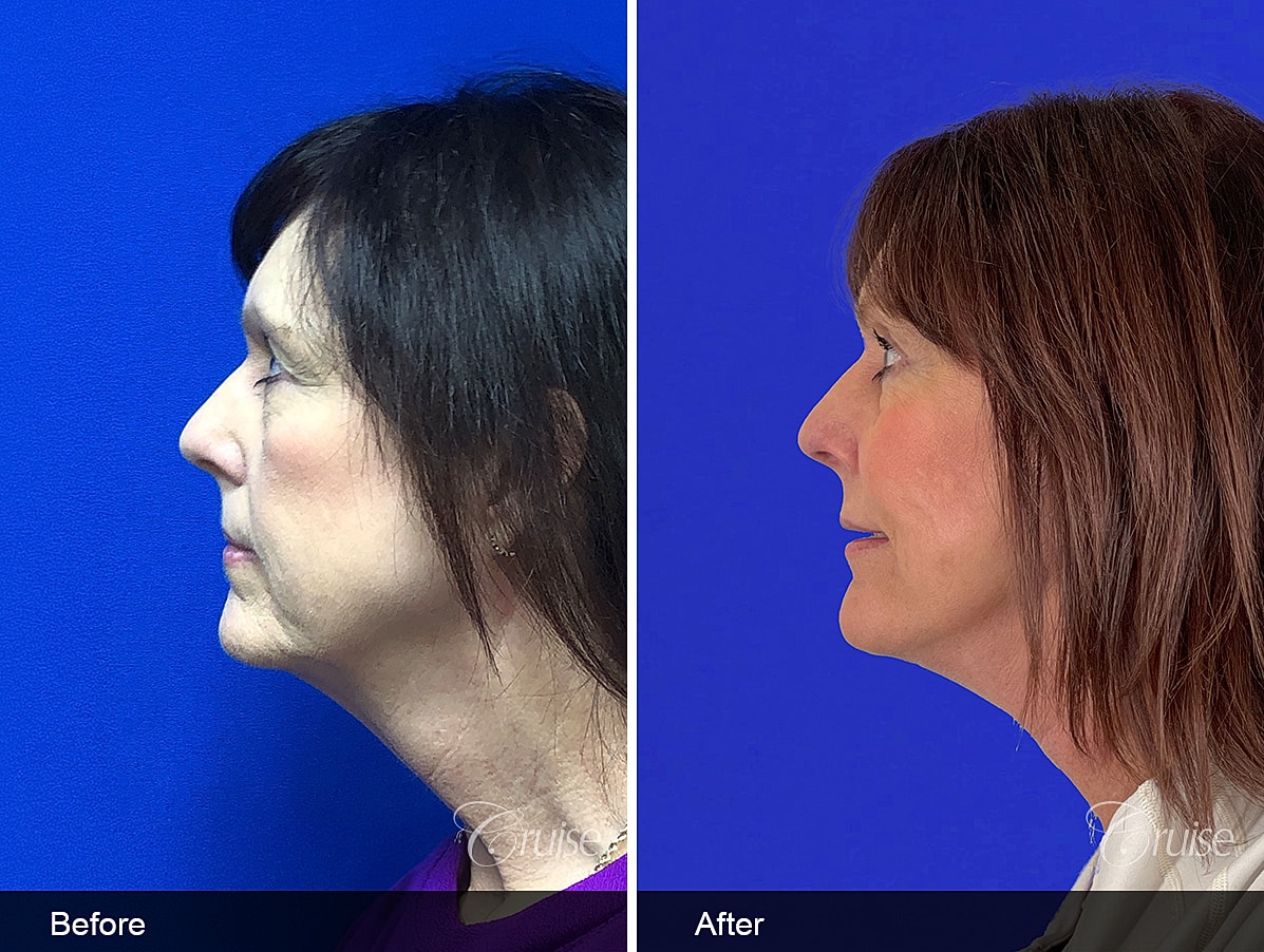 Face Lift Before & After