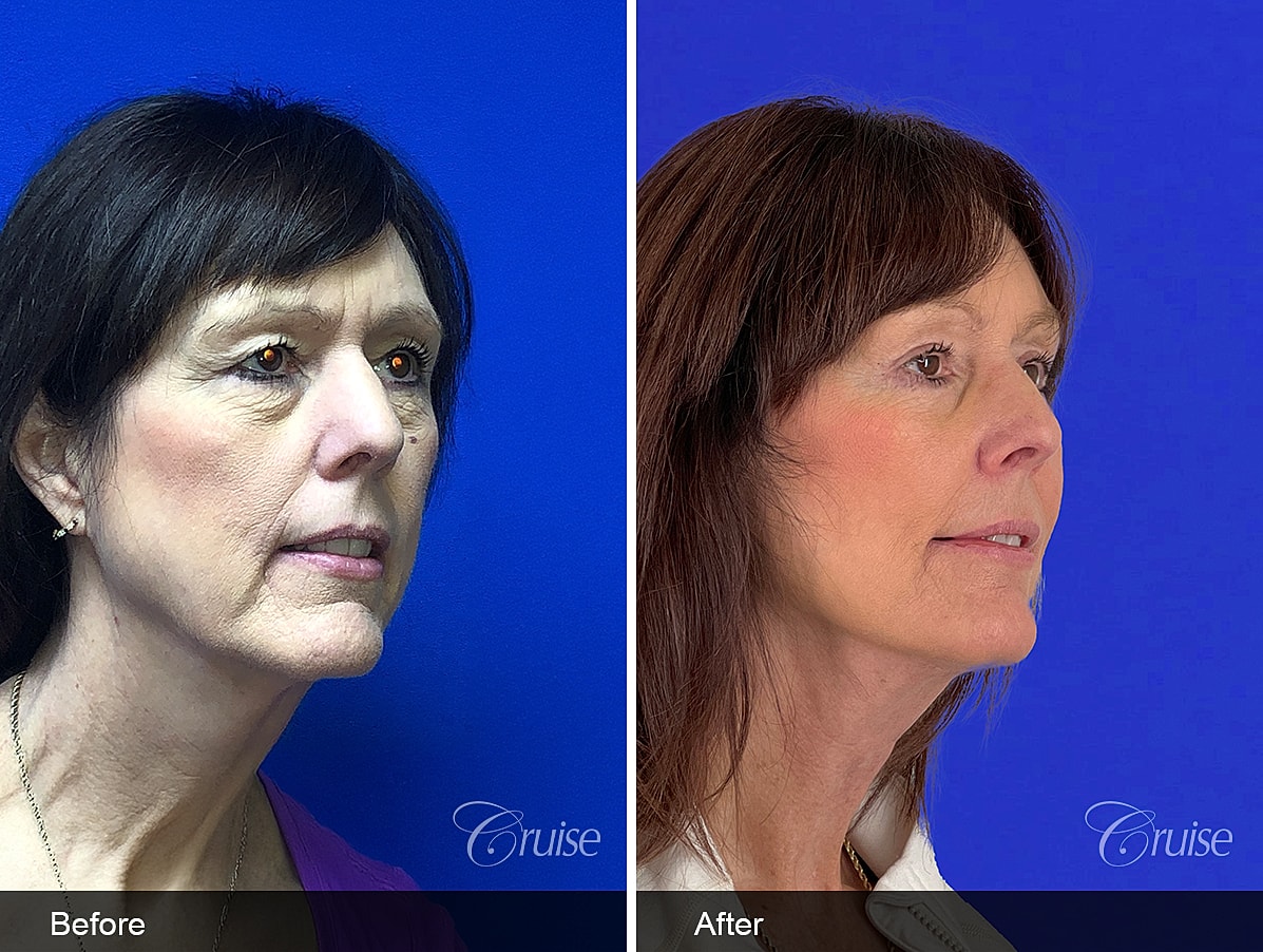Face Lift Before & After