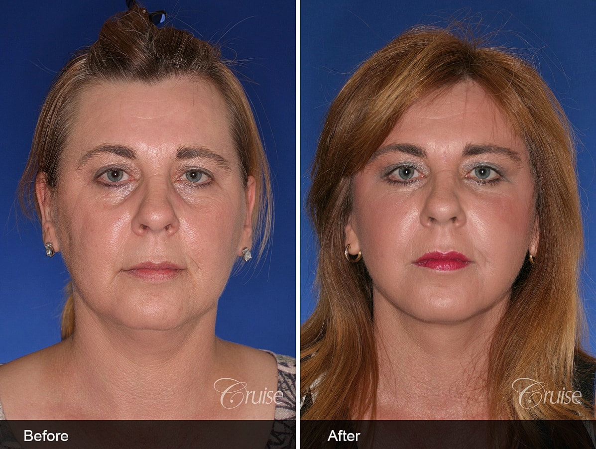 Face Lift Before & After