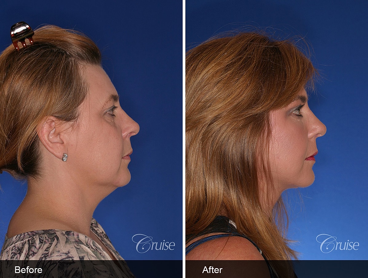 Face Lift Before & After