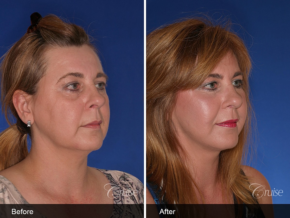 Face Lift Before & After