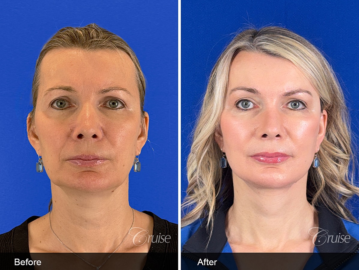 Face Lift Before & After