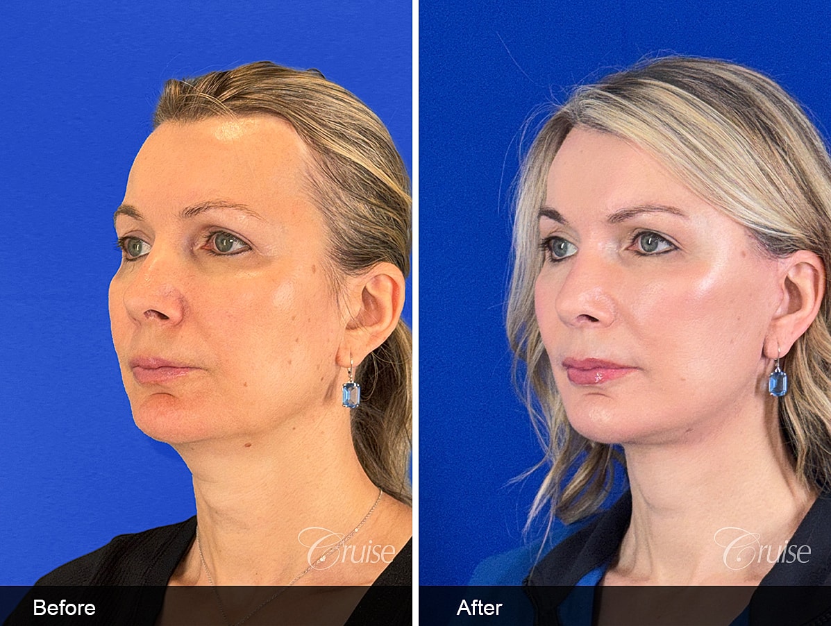 Face Lift Before & After