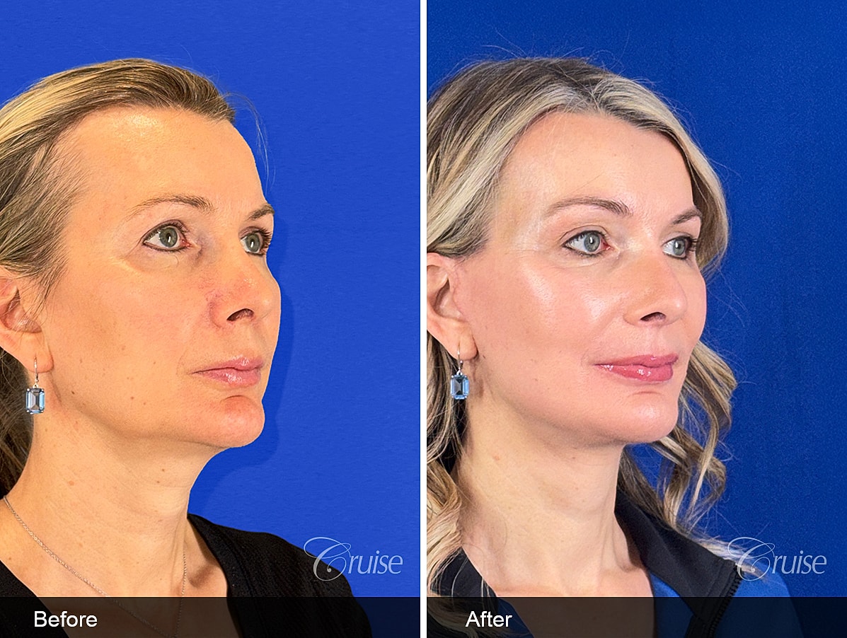 Face Lift Before & After