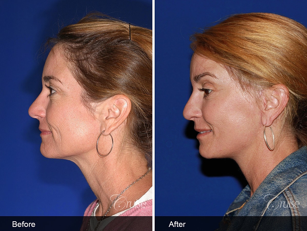 Face Lift Before & After