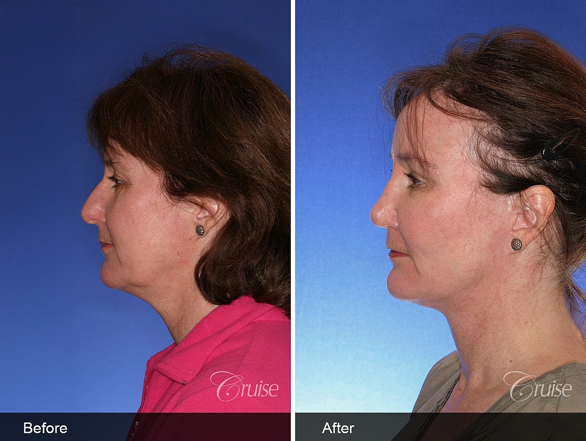 Face Lift Before & After