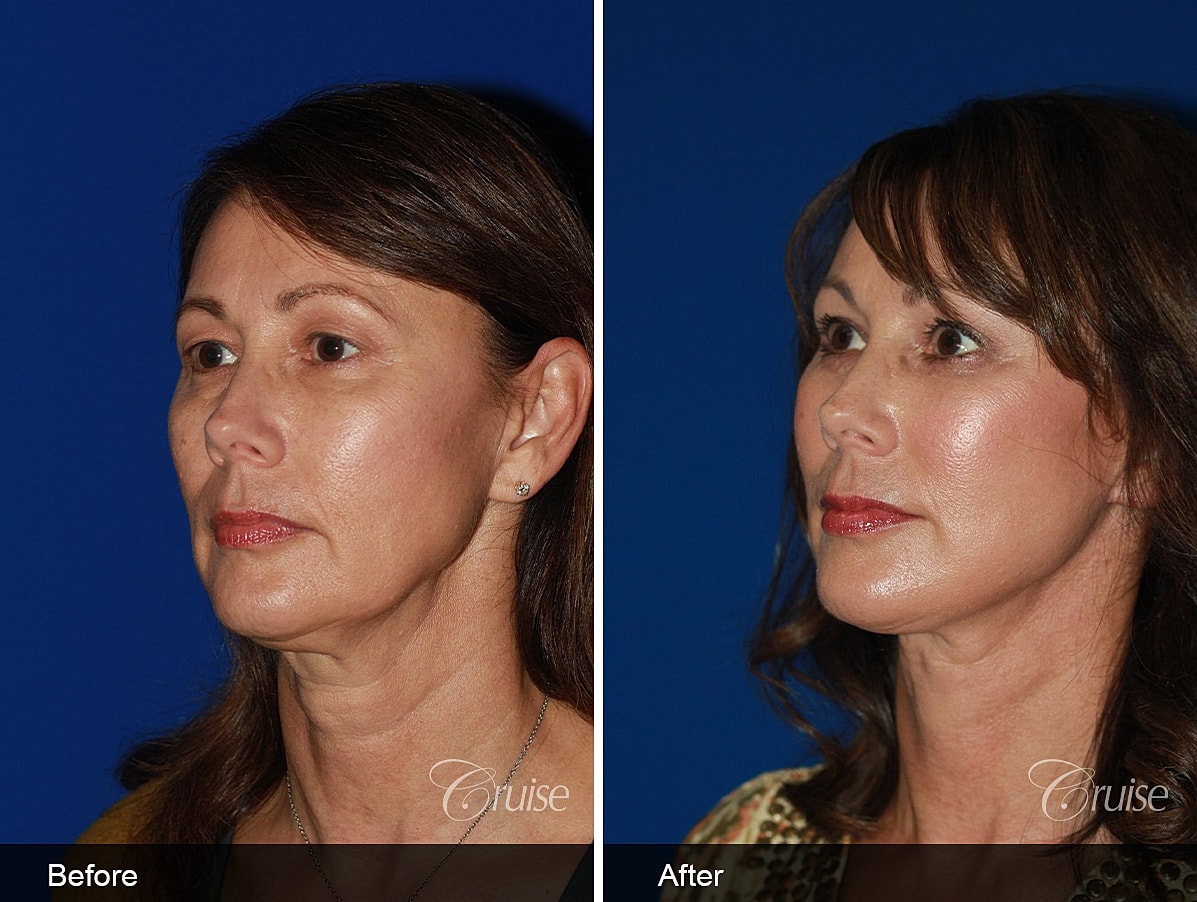 Face Lift Before & After