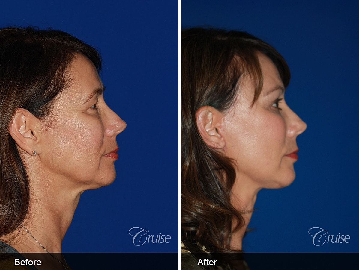 Face Lift Before & After