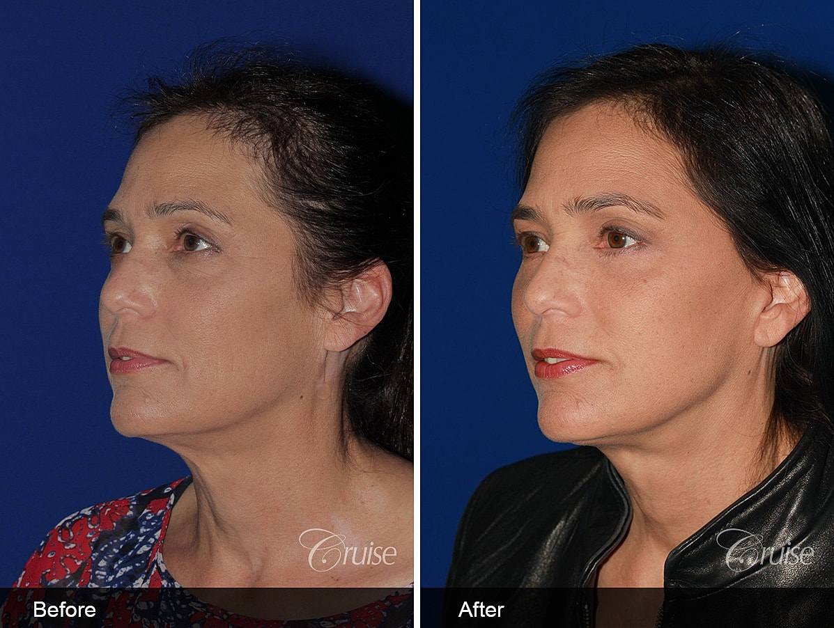 Face Lift Before & After
