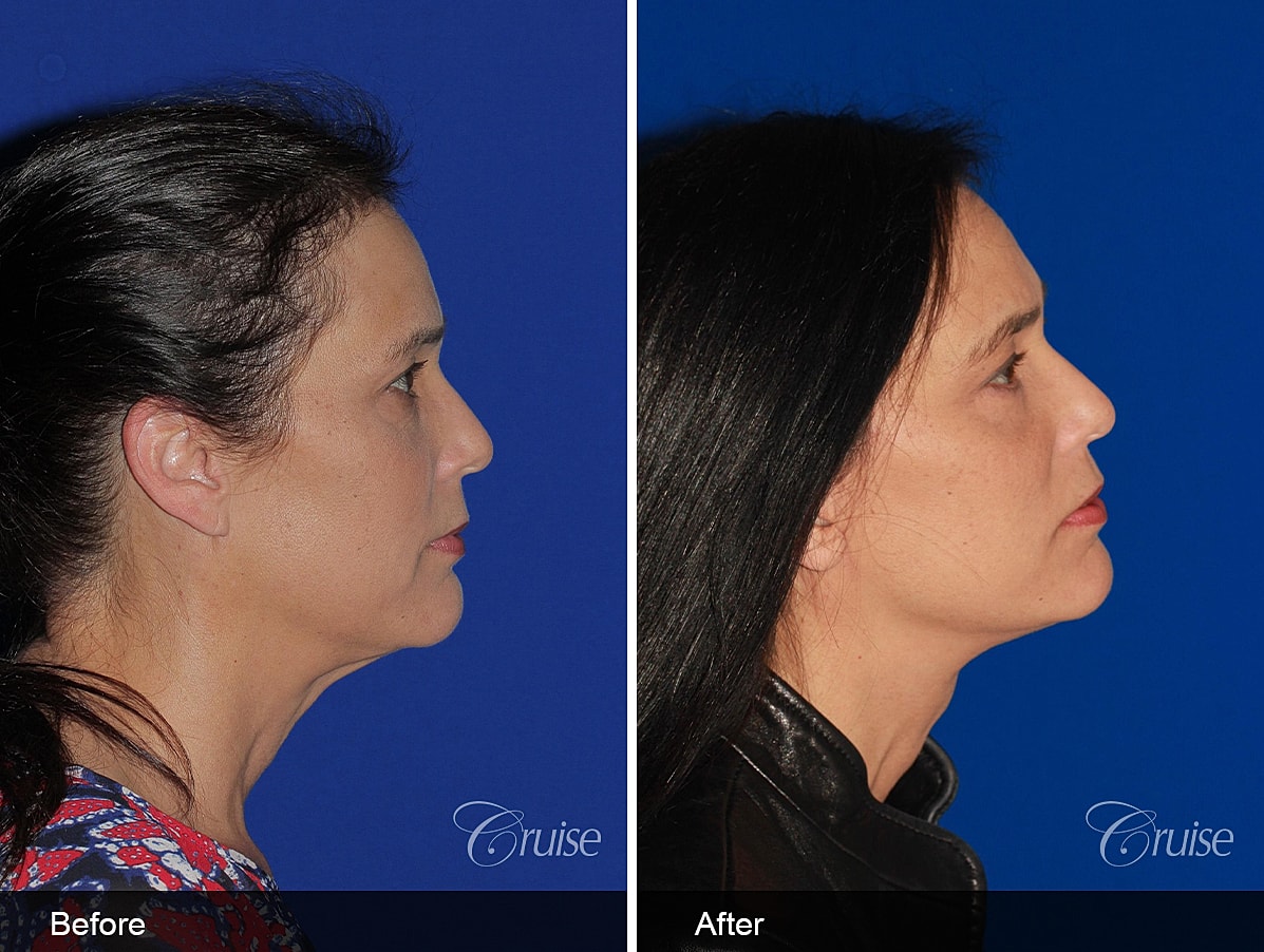 Face Lift Before & After