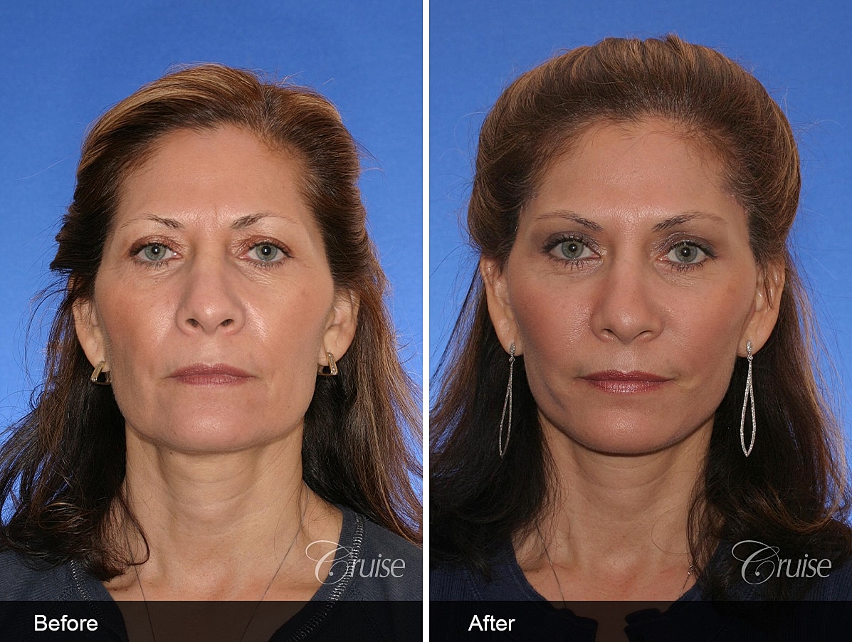 Face Lift Before & After