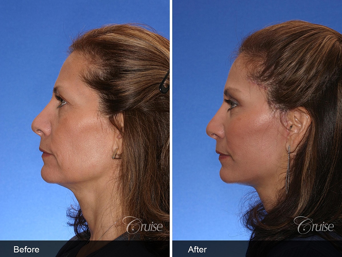 Face Lift Before & After
