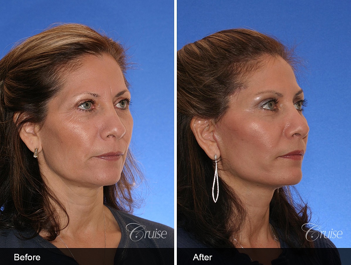 Face Lift Before & After
