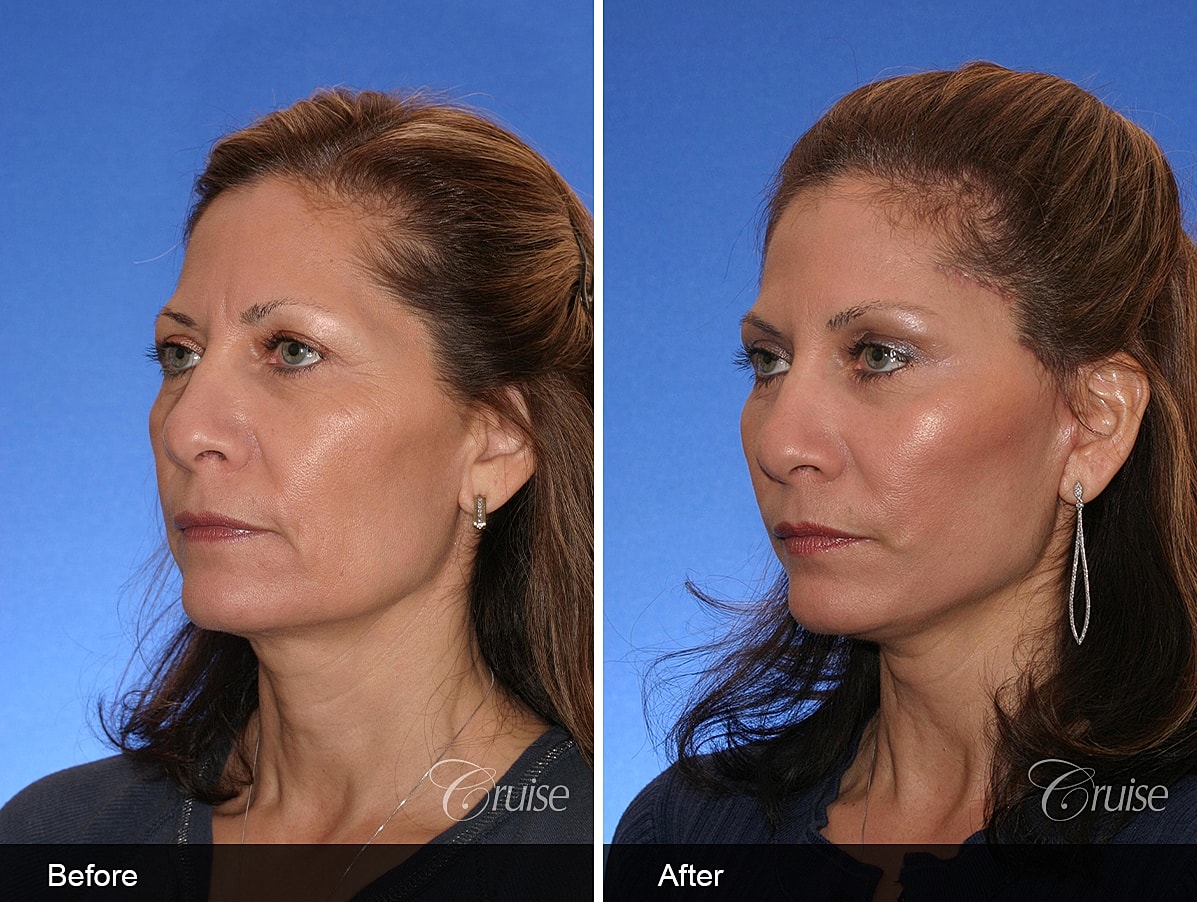 Face Lift Before & After