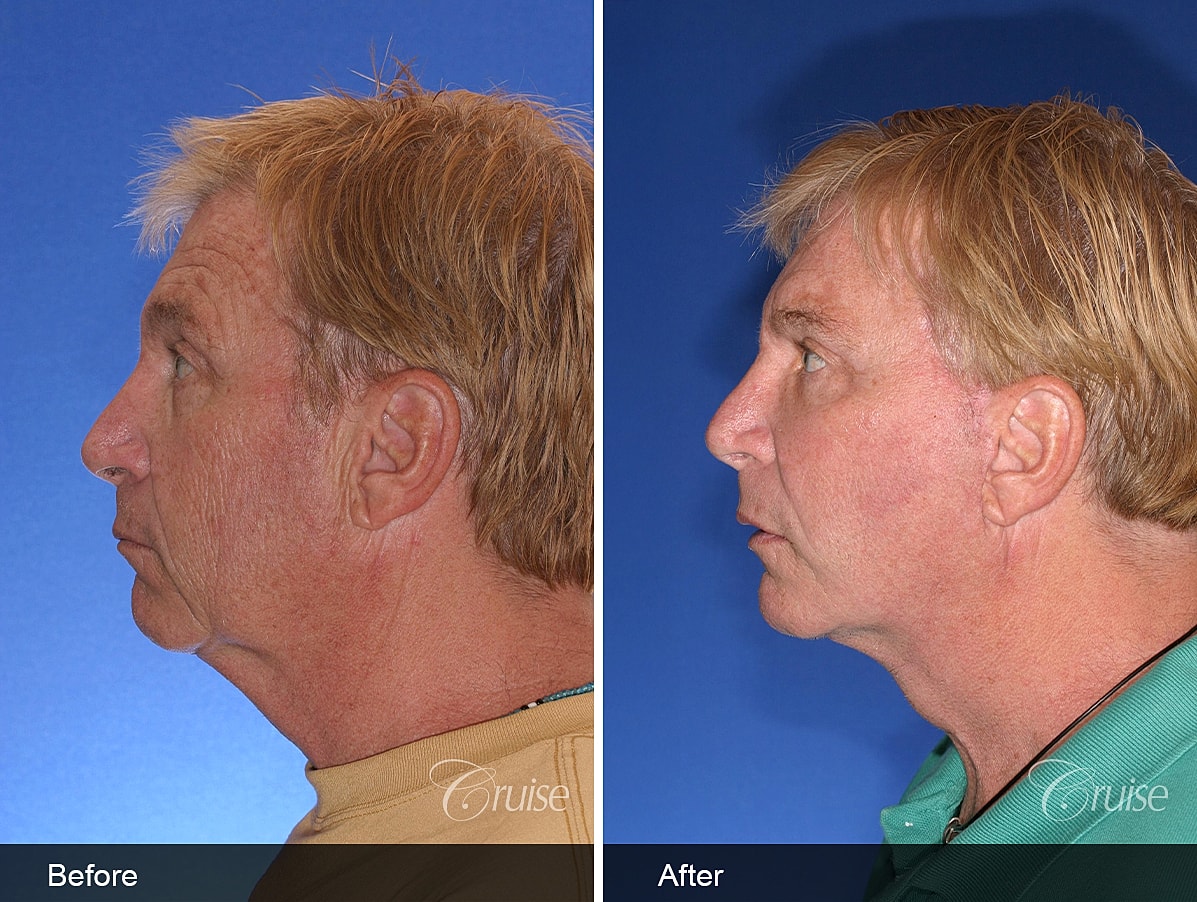 Face Lift Before & After