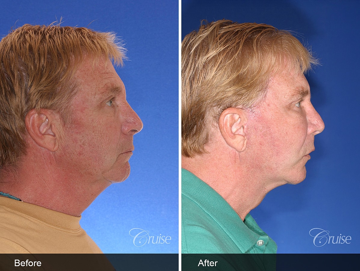 Face Lift Before & After