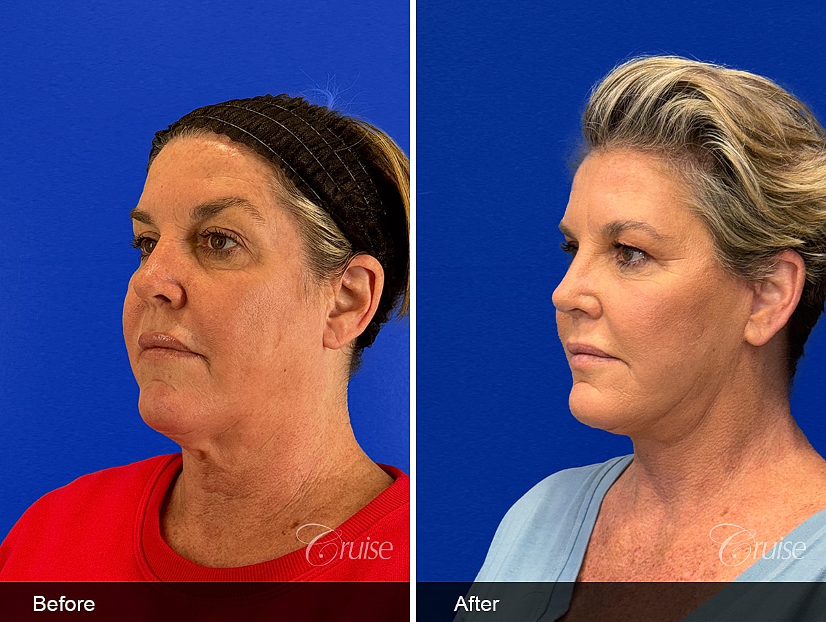 Face Lift Before & After