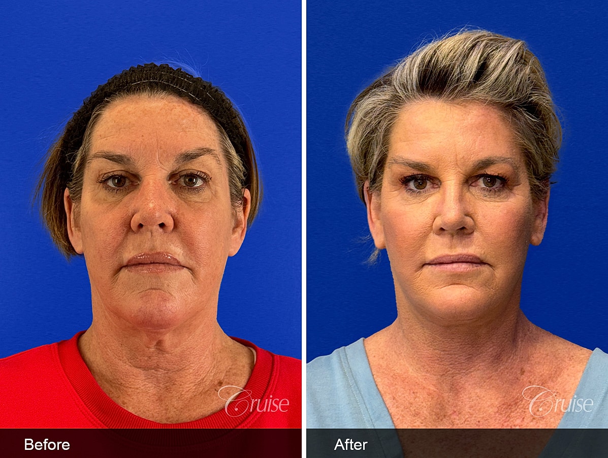 Face Lift Before & After