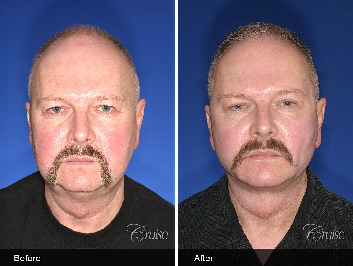 Face Lift Before & After