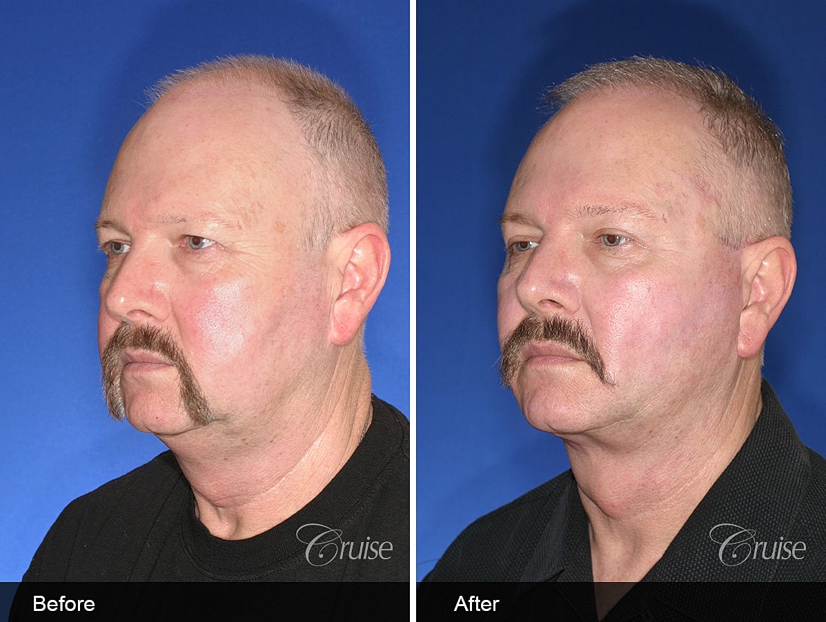 Face Lift Before & After