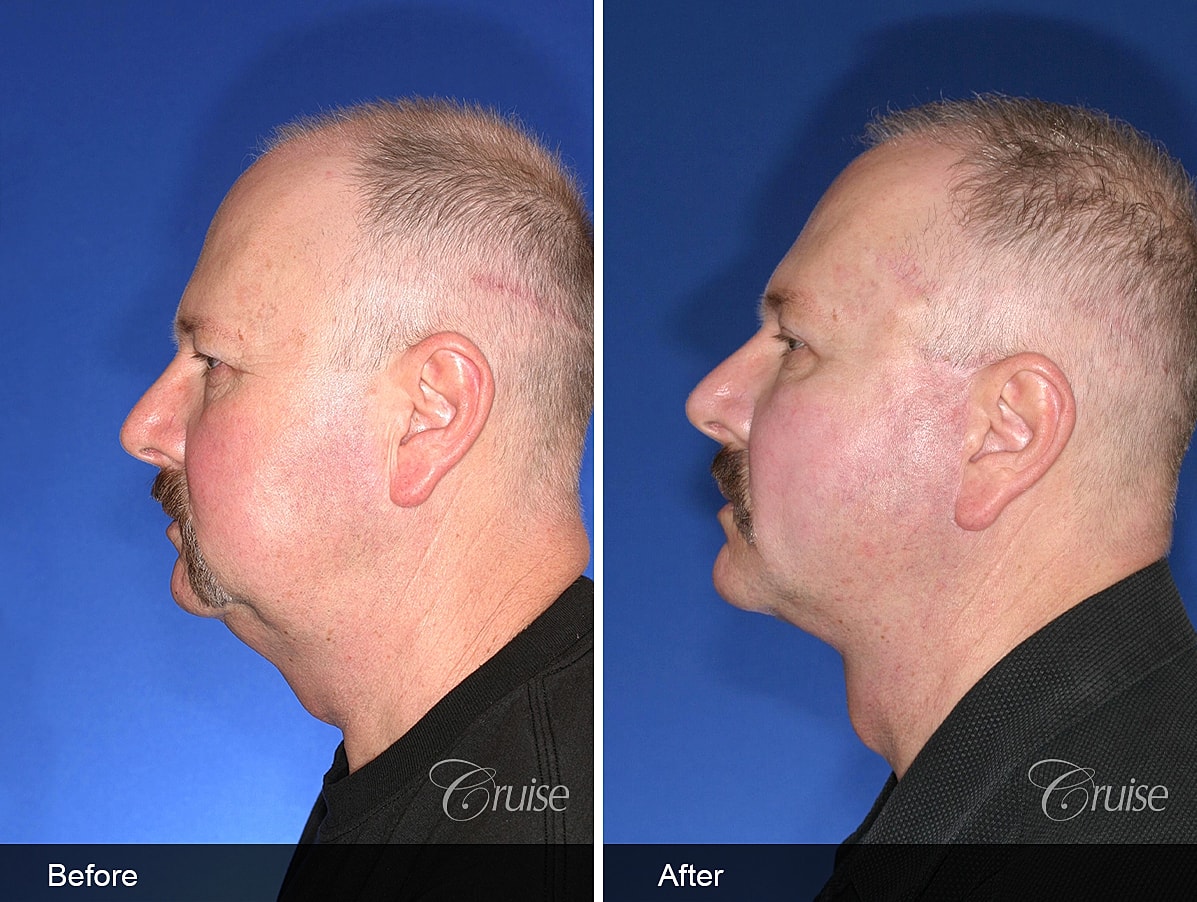 Face Lift Before & After