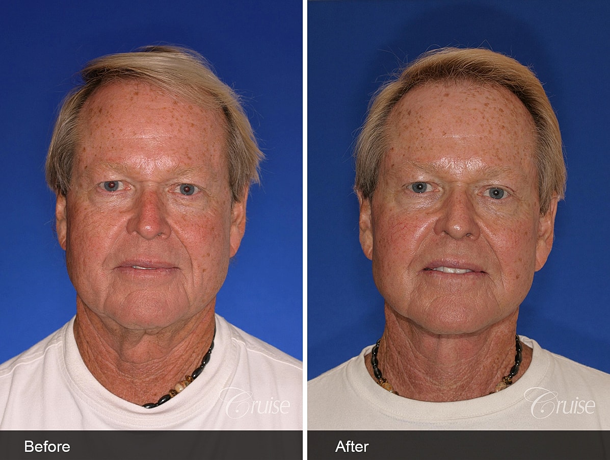 Face Lift Before & After
