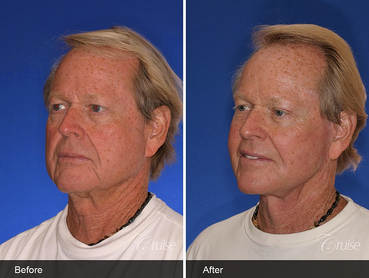 Face Lift Before & After