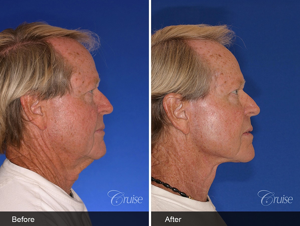 Face Lift Before & After