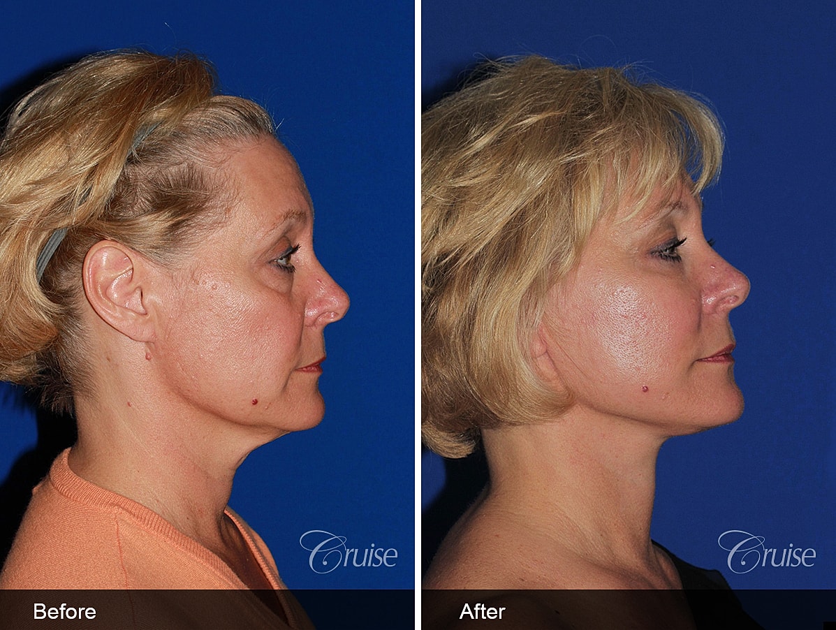 Face Lift Before & After