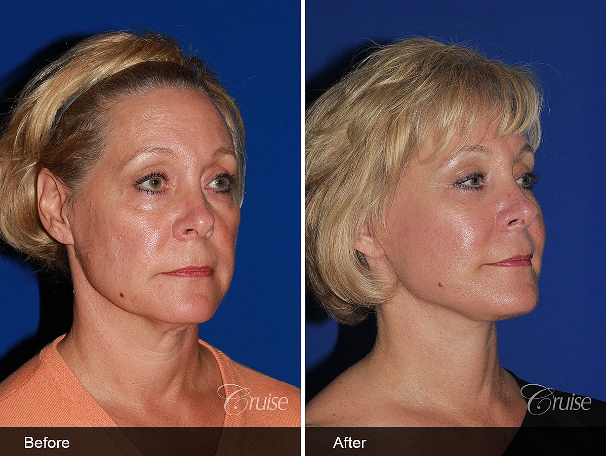 Face Lift Before & After