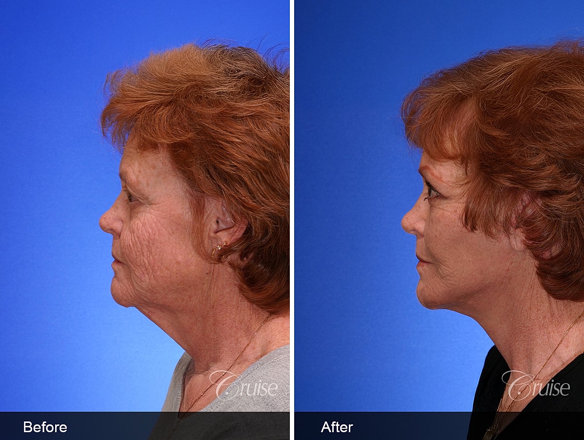 Face Lift Before & After