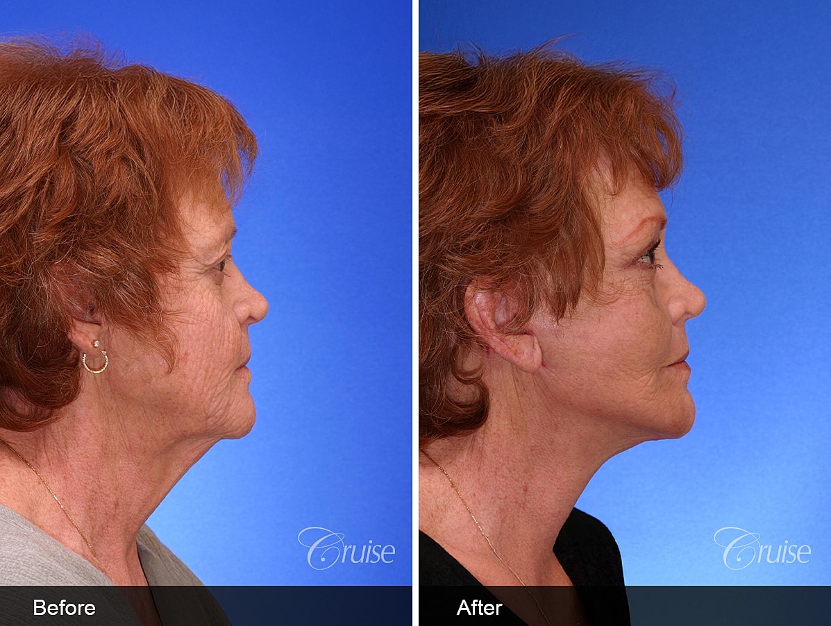 Face Lift Before & After