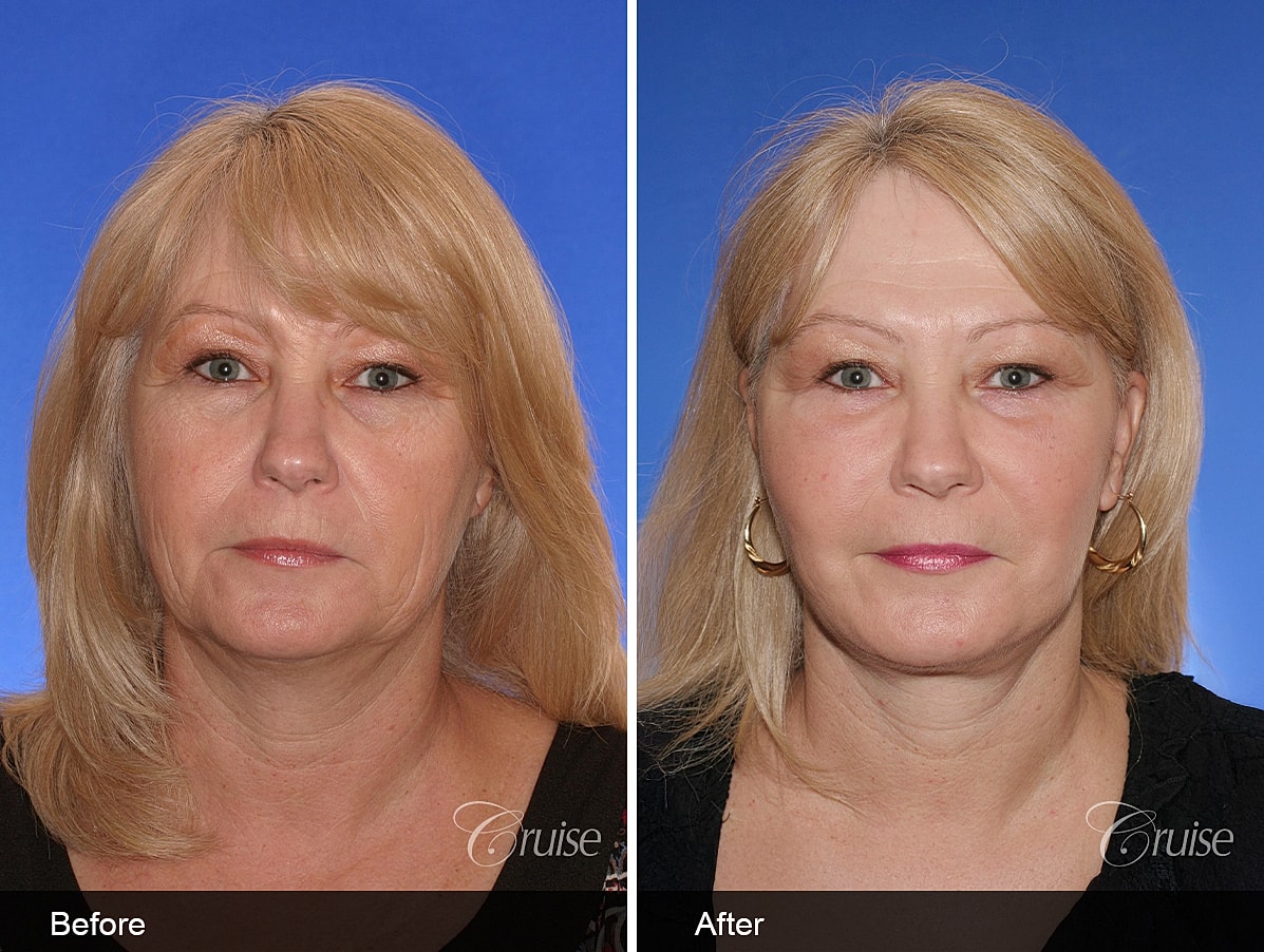 Face Lift Before & After