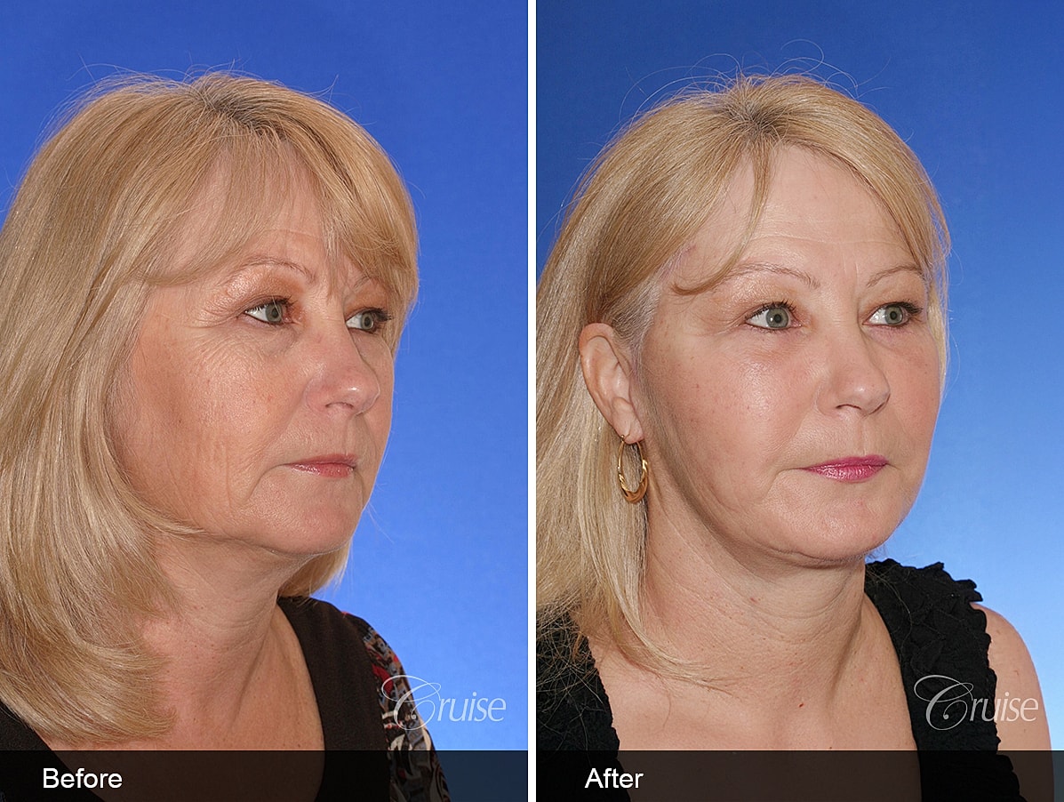 Face Lift Before & After