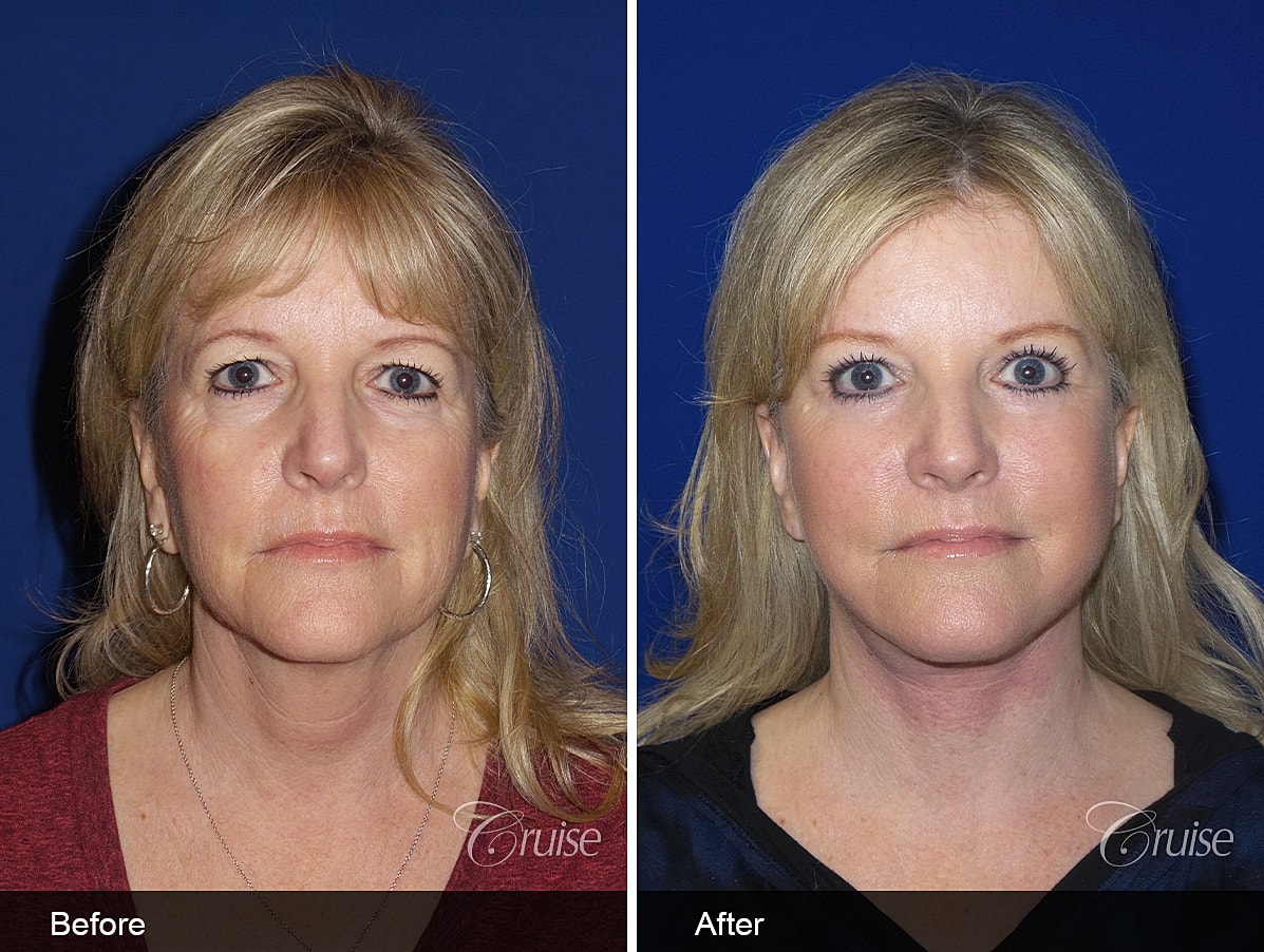 Face Lift Before & After
