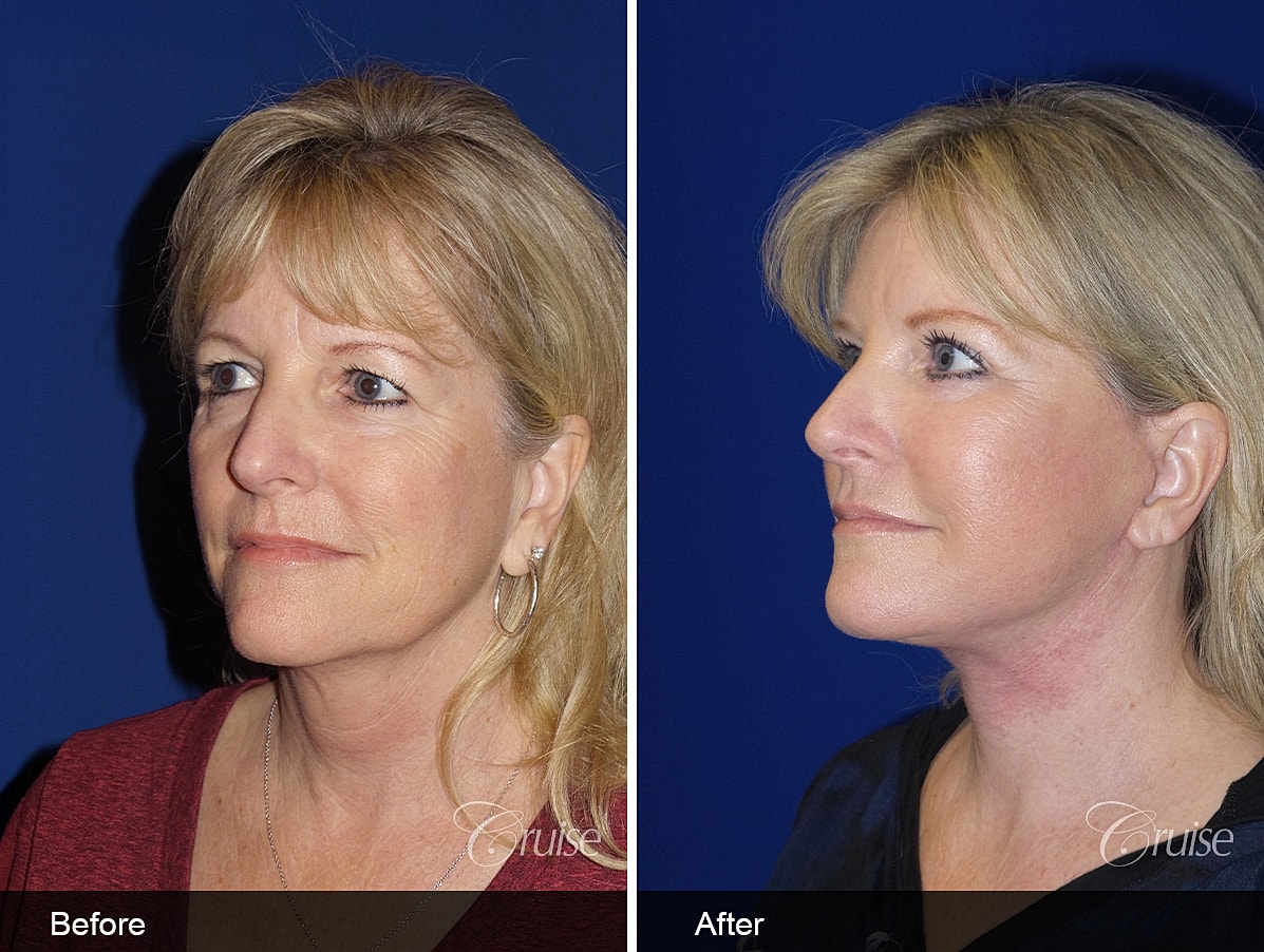 Face Lift Before & After