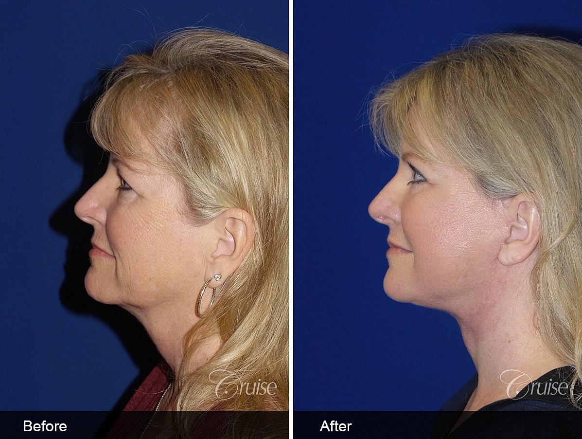 Face Lift Before & After