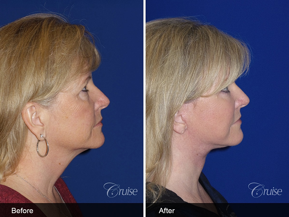 Face Lift Before & After